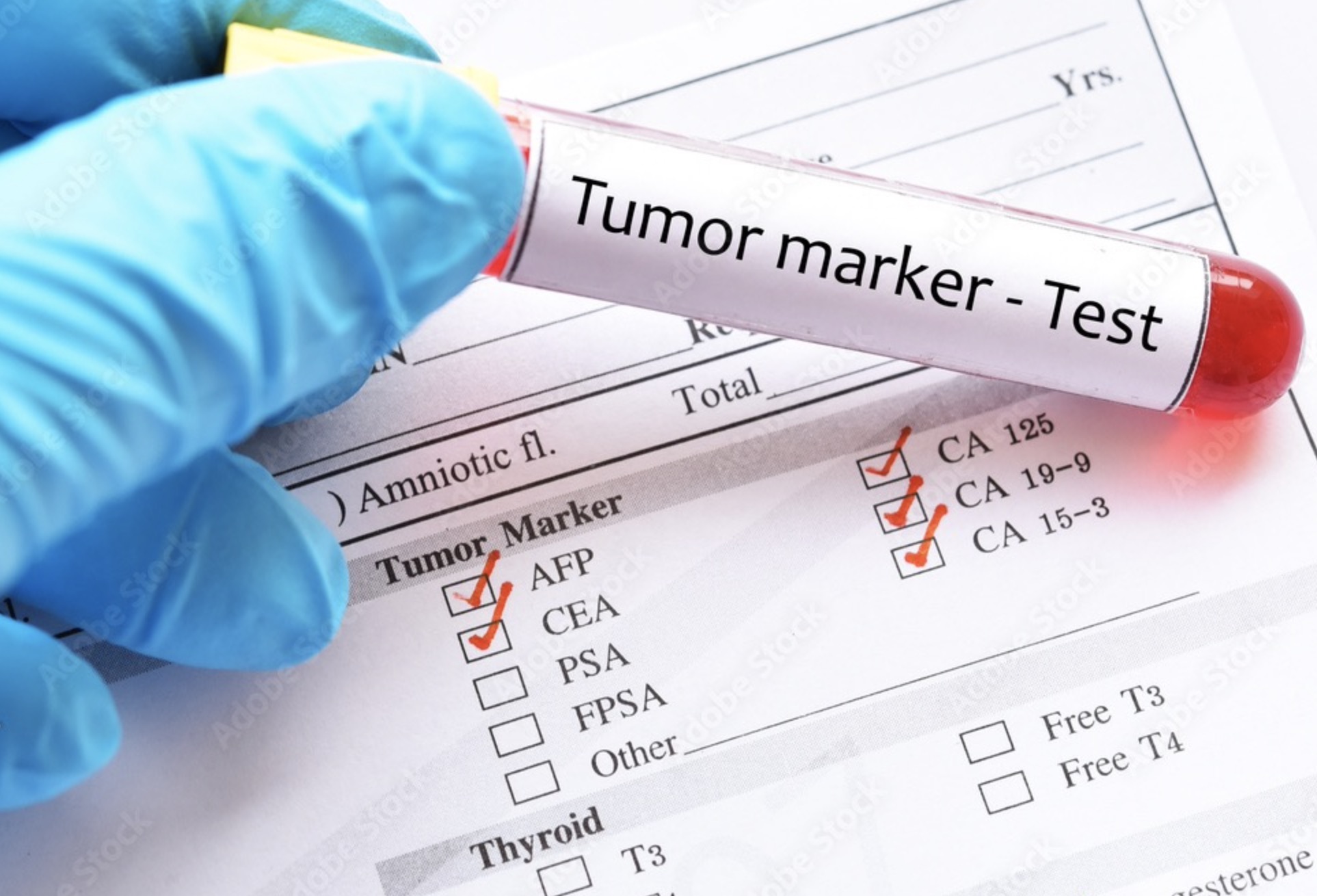 A complete list of 49 tumor markers!